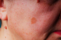 Age spots, moles and freckles on the face close-up. Spots on the skin of the face. Texture of middle