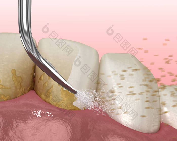 口腔卫生：烫伤和根部修整（常规牙周病治疗） 。医学上准确的人类牙齿治疗三维图像