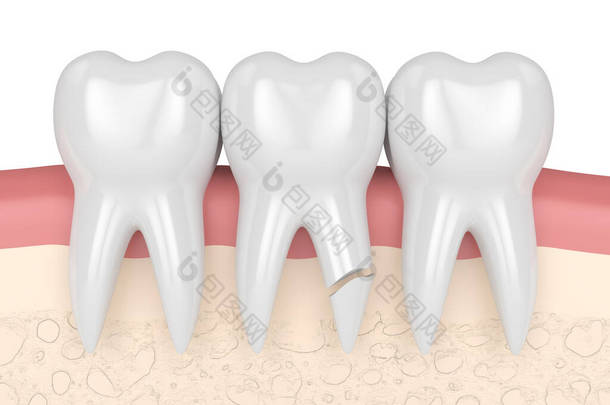 牙根<strong>开裂</strong>的牙龈在白底上的3D呈现。不同类型的断牙概念.