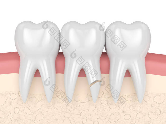 牙根开裂的牙龈在白底上的3D呈现。不同类型的断牙概念.