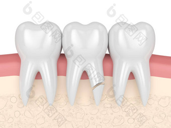 牙根开裂的牙龈在白底上的3D呈现。不同类型的断牙概念.图片