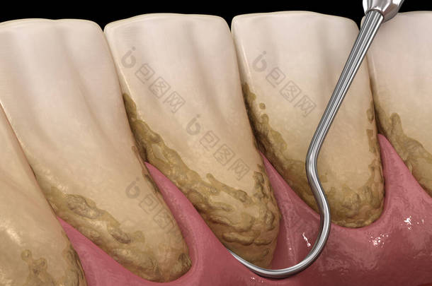 口腔卫生：烫伤和根部修整（常规牙周病治疗） 。医学上准确的人类牙齿治疗三维图像