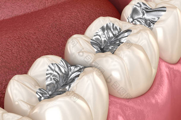 海藻酰胺的<strong>修复</strong>。牙科概念的医学上准确的3D动画