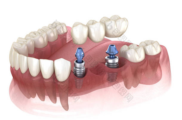 由植入物支撑的牙桥.医学上准确的人类牙齿和假牙概念三维图像