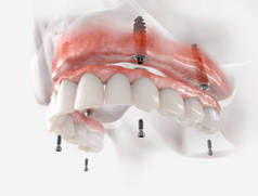 上颌固定修复4个植入物。现实的3D例证.