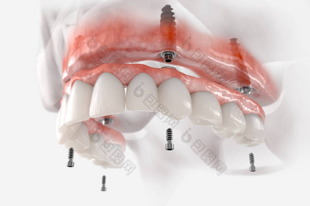 上颌固定<strong>修复</strong>4个植入物。现实的3D例证.