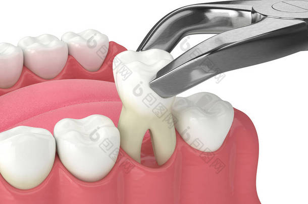 牙钳拔牙下颌骨3D成形术