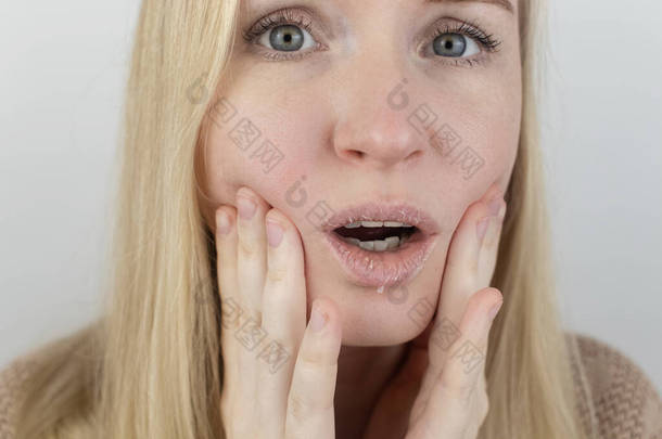 女人在嘴唇上检查干枯的皮肤.剥皮，粗糙，不适，皮肤敏感。皮肤科医生或美容师指定的病人。干皮片的特写