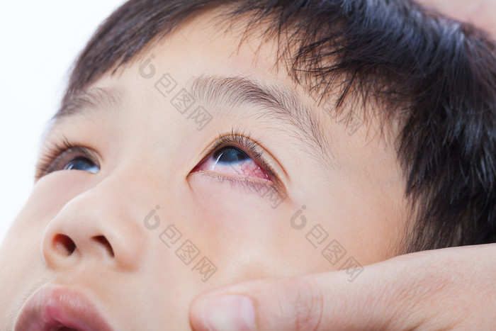 特写红眼病结膜炎感染图片-包图网企业站