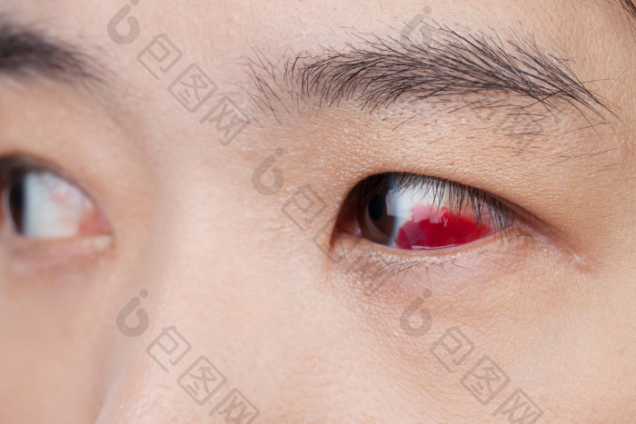 特写红眼病结膜炎感染-包图企业站