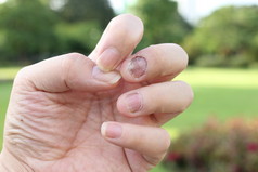 指甲源真菌感染, 手指甲真菌病. 