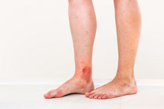 被昆虫咬伤的病人腿上的红色皮疹