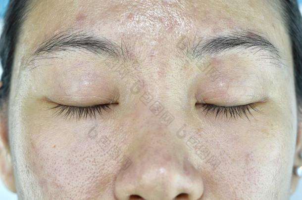 面部皮肤问题, 成人老化问题, <strong>皱纹</strong>, 痤疮疤痕, 大毛孔, 黑斑, 脱水皮肤.