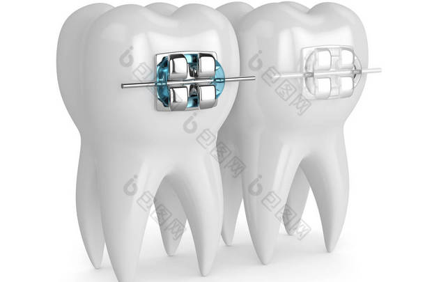 3d. 用<strong>陶瓷</strong>和金属大括号渲染牙齿