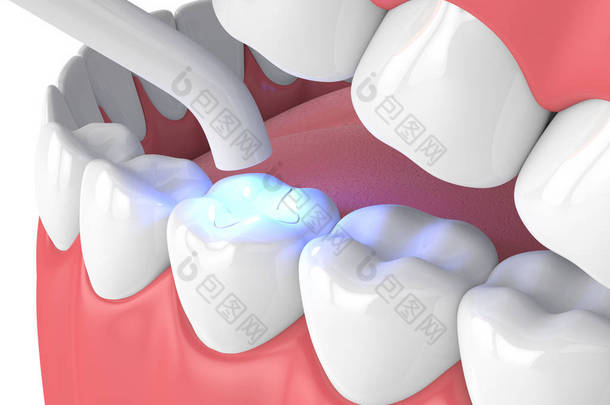3d 渲染下巴与牙科聚合灯和光固化镶嵌填充在白色背景