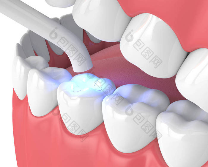 3d 渲染下巴与牙科聚合灯和光固化镶嵌填充在白色背景
