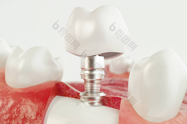 牙人体植入物。牙科的概念。人的牙齿或假牙。3d 渲染