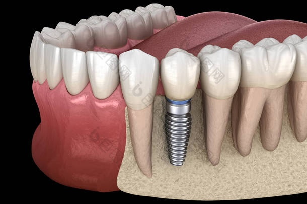 前磨牙修复植入物。医学上准确的人类牙齿和假牙概念三维图像