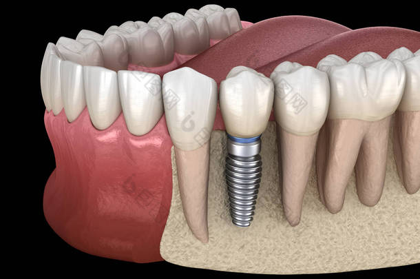 前磨牙<strong>修复</strong>植入物。医学上准确的人类牙齿和假牙概念三维<strong>图像</strong>