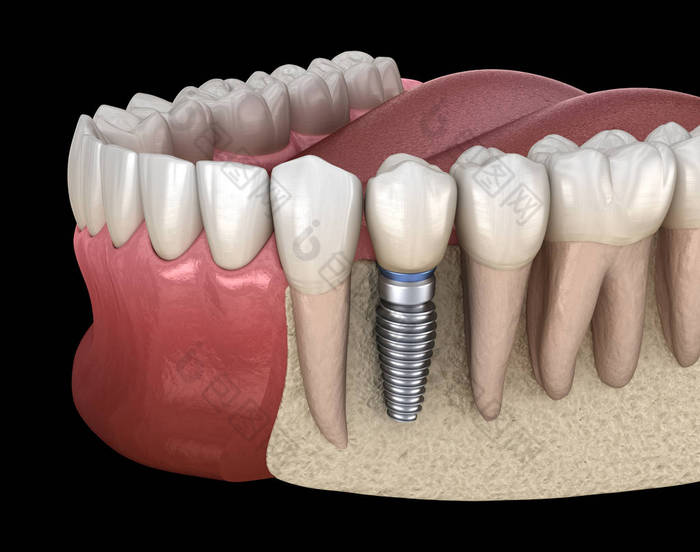 前磨牙修复植入物。医学上准确的人类牙齿和假牙概念三维图像