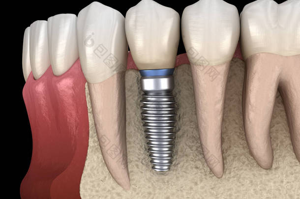 前磨牙<strong>修复</strong>植入物。医学上准确的人类牙齿和假牙概念三维图像