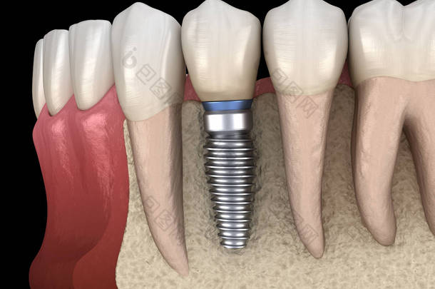 前磨牙修复植入物。医学上准确的人类牙齿和假牙概念三维图像