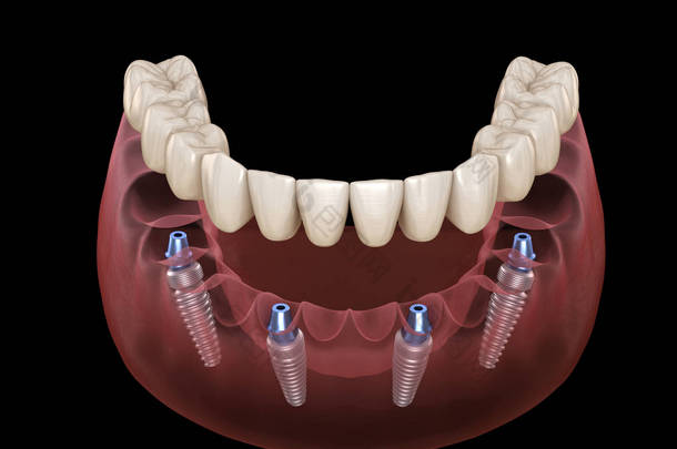 下颌骨假体全部安装在由植入物支撑的4个系统上。医学上准确的人类牙齿和假牙概念三维图像