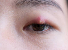 亚洲年轻女子与棕色眼睛与stye感染的特写