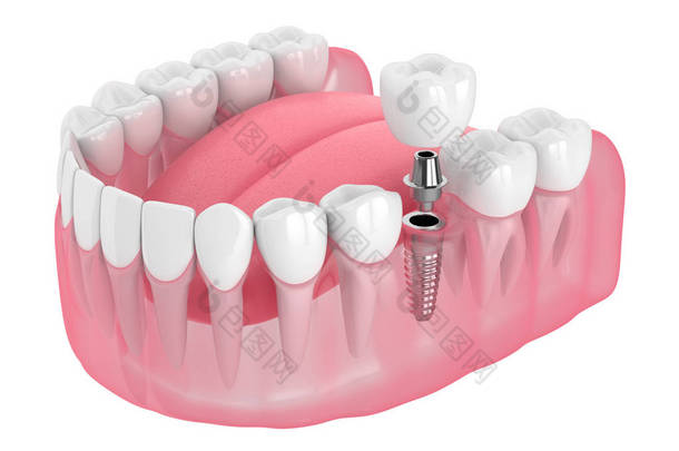 带牙科植入物的颌骨3d渲染