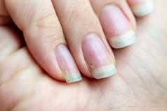 修复后有问题的修复修复的损坏的指甲。健康和美容问题.