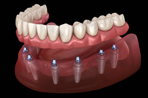 下颌假肢 所有8个系统支持植入物。人类牙齿和假牙概念的医学上精确的三维插图