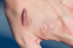 事故发生后，人手皮肤上的酮形疤痕（肥大疤痕）。手腕皮肤上的骨质疤痕由汽车意外手术引起 