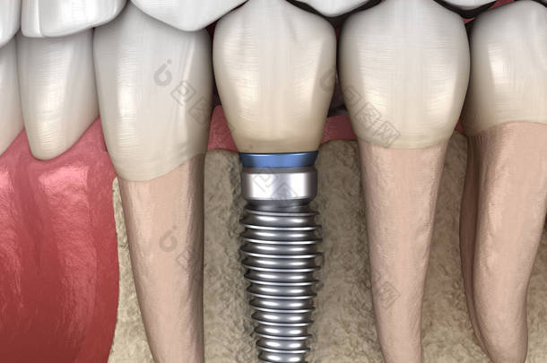 前磨牙修复植入物。医学上准确的人类牙齿和假牙概念三维图像
