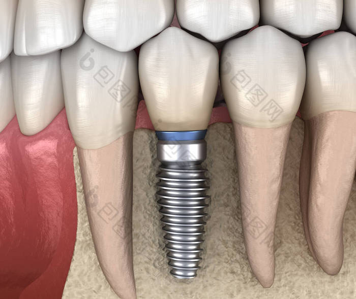 前磨牙修复植入物。医学上准确的人类牙齿和假牙概念三维图像