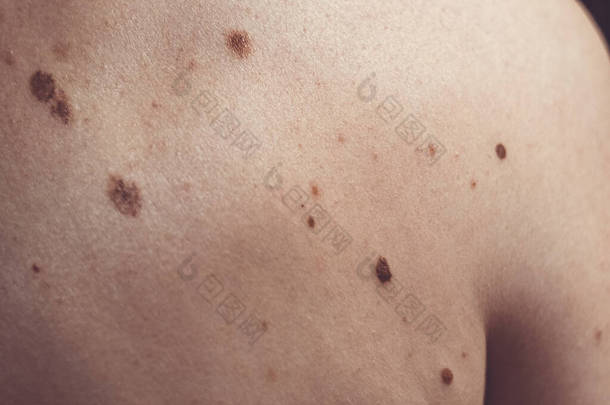 来自西班牙的一个37岁的高加索人身上的黑色素瘤状的痣，其中一些是畸形或非典型的