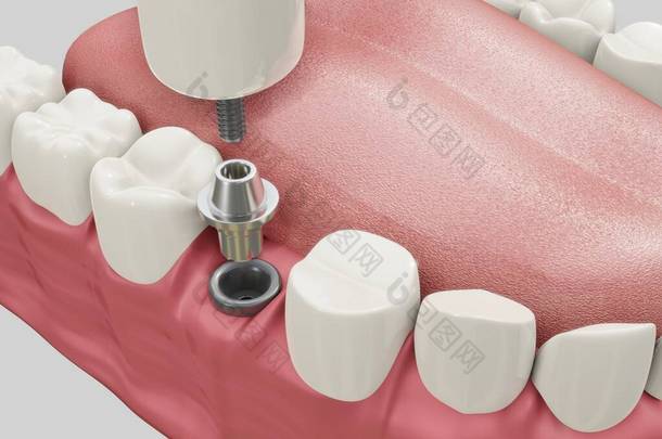 <strong>牙科</strong>植入物<strong>治疗</strong>程序. 医学上准确的3D图例假牙概念.