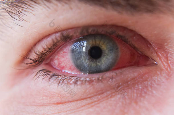 结膜炎感染合并红眼巨乳闭锁