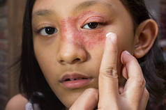 东南亚裔少女，脸部环状皮疹，眼部和鼻部周围，用抗真菌霜进行药物治疗。Tinea公司皮炎皮肤问题
