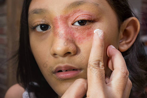东南亚裔少女，脸部环状皮疹，眼部和<strong>鼻部</strong>周围，用抗真菌霜进行药物治疗。Tinea公司皮炎皮肤问题