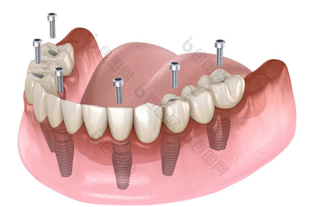下颌骨假体全部在4个系统上，由植入物支撑，螺钉固定。牙科概念的医学上准确的3D图像