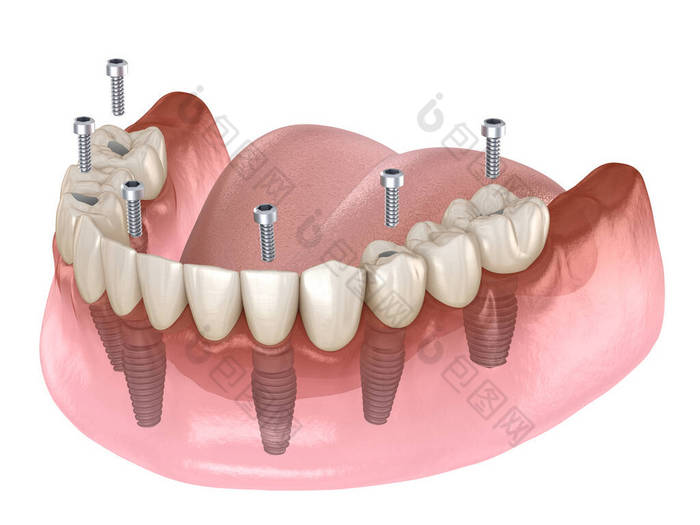 下颌骨假体全部在4个系统上，由植入物支撑，螺钉固定。牙科概念的医学上准确的3D图像