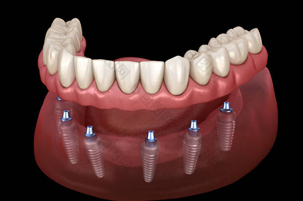 下颌骨假体全部安装在6个由植入物支撑的系统上。医学上准确的人类牙齿和假牙概念三维图像