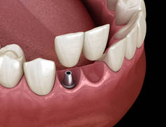 悬臂桥植入物基，额牙恢复。牙科概念的医学上准确的3D动画