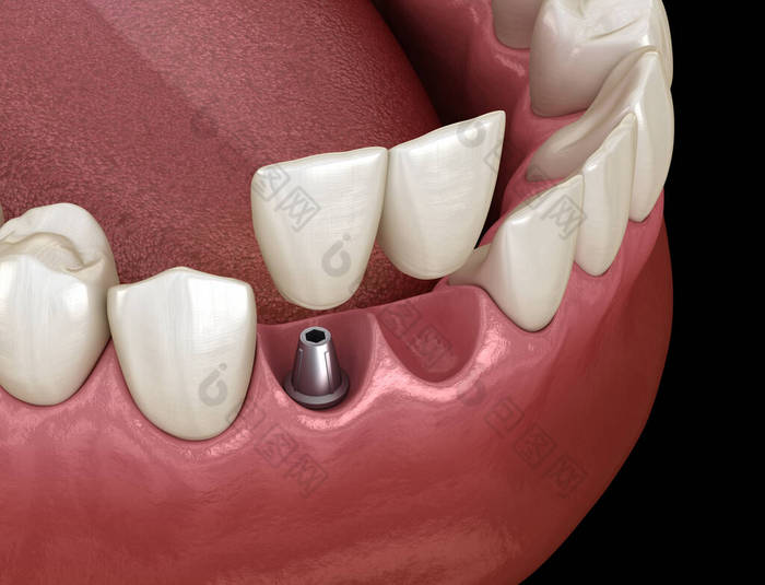 悬臂桥植入物基，额牙恢复。牙科概念的医学上准确的3D动画