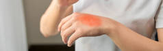 女人的手有红疹痒，原因是对奶油或空气过敏.
