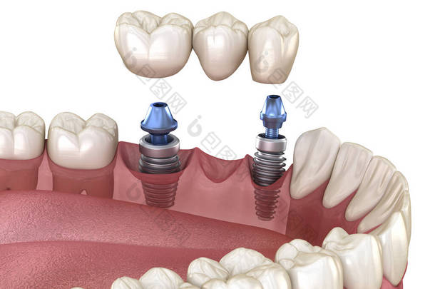 由植入物支撑的牙桥.医学上准确的人类牙齿和假牙概念三维图像