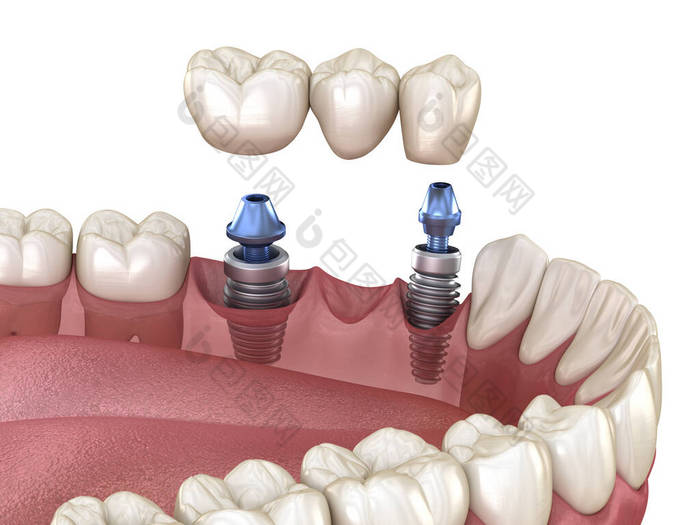 由植入物支撑的牙桥.医学上准确的人类牙齿和假牙概念三维图像