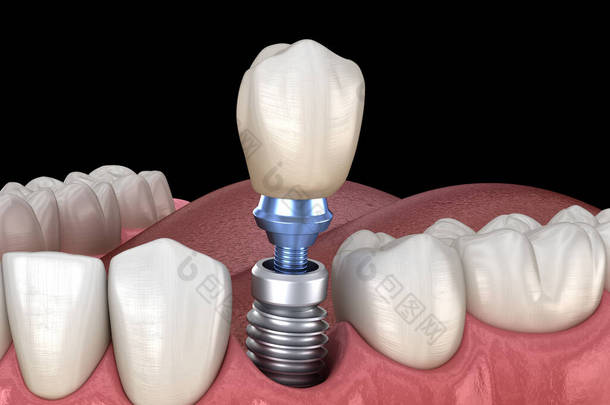 前磨牙<strong>修复</strong>植入物。医学上准确的人类牙齿和假牙概念三维<strong>图像</strong>