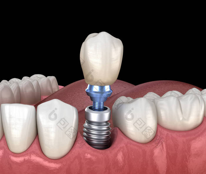 前磨牙修复植入物。医学上准确的人类牙齿和假牙概念三维图像
