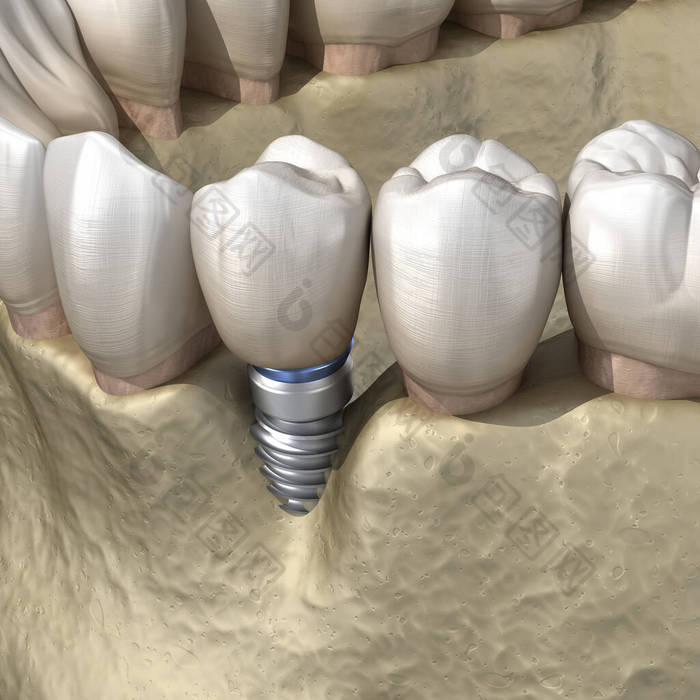 种植体周围可见骨质疏松症.牙科植入物概念的医学上准确的三维图解